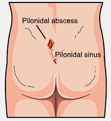What is Pilonidal Sinus