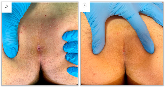 pilonidal sinus pictures​