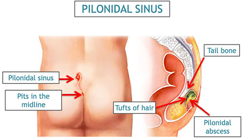pilonidal sinus in hindi
