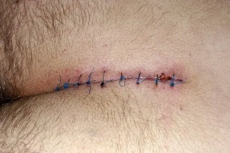 pilonidal sinus surgery cost