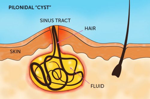 Symptoms of Early Stage Pilonidal Sinus