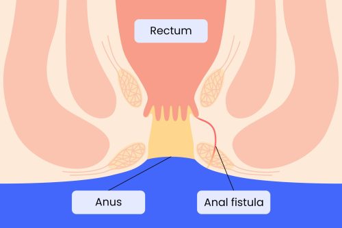 Anal Fistula