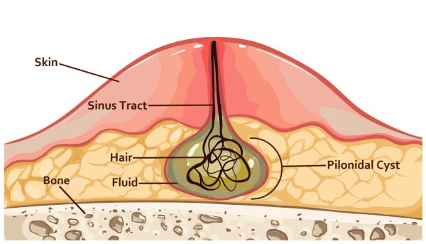 how to get rid of pilonidal sinus