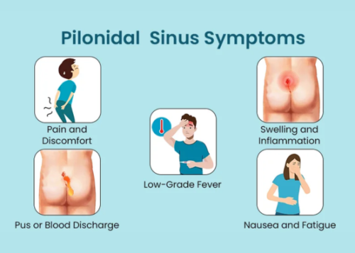 pilonidal sinus slideshare