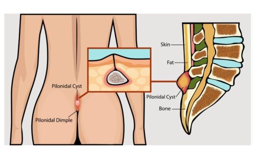 pilonidal sinus pictures pilonidal sinus pictures