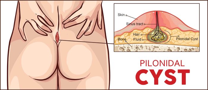 is pilonidal sinus dangerous