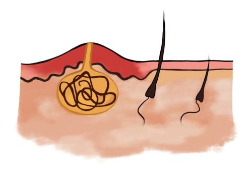 spreading skin infection spreading skin infection